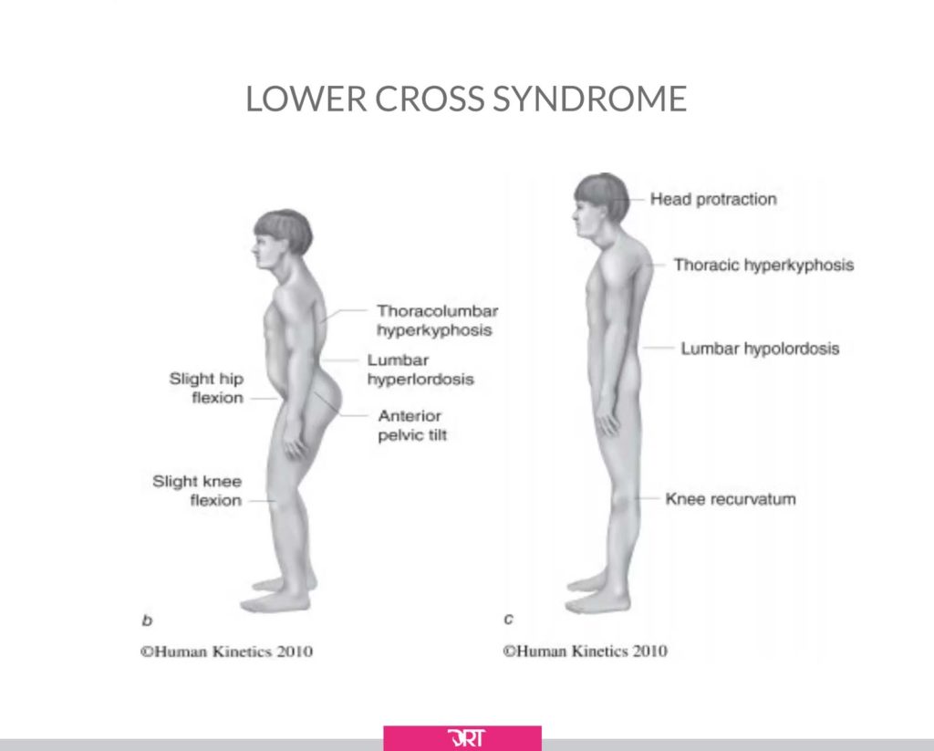 lower cross syndrome